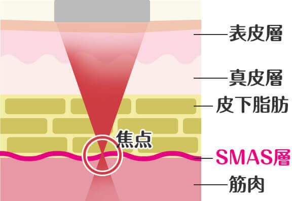 ハイフ（HIFU)とは？