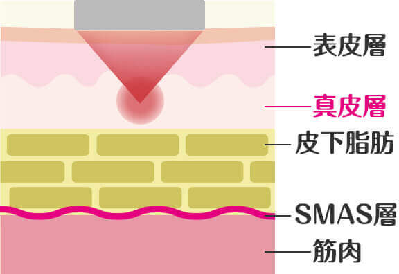 肌質改善には「ハイフシャワー」がおすすめ